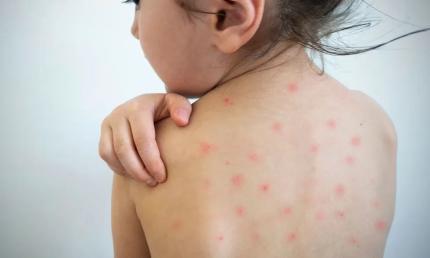 Cinci cazuri de rujeolă confirmate la Cahul de la începutul anului. ANSP informează despre situația epidemiologică